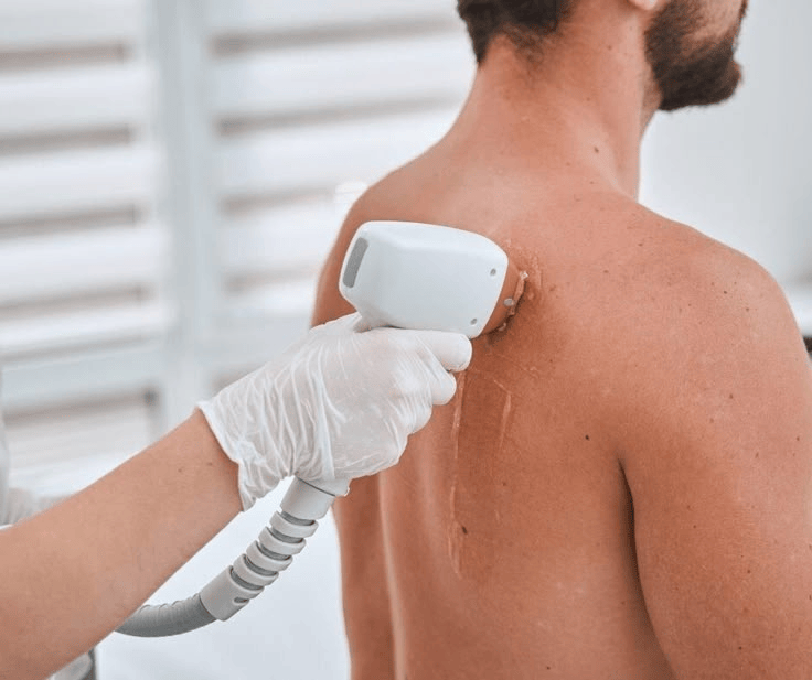 Taller de Depilación Láser